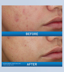 CeraVe Acne Foaming Cream Wash 10% 150ml